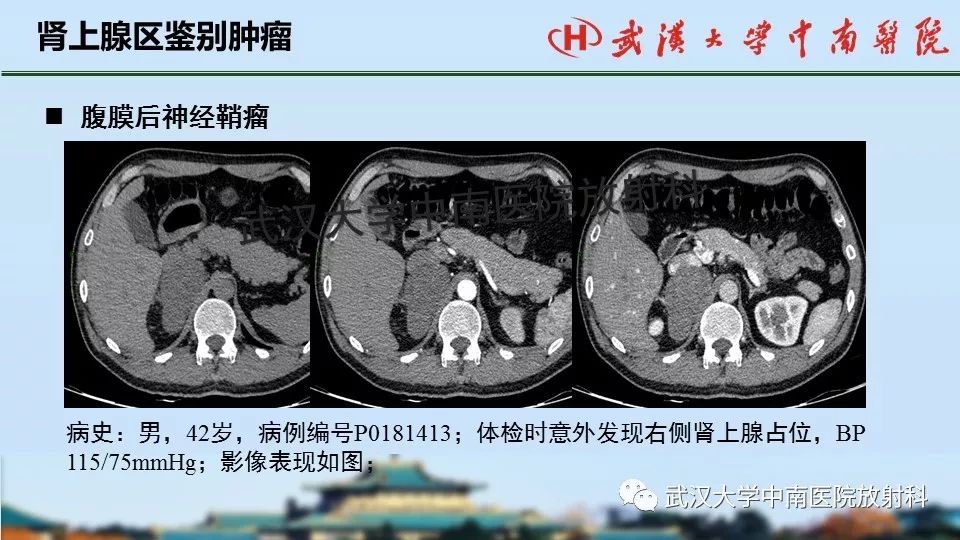 【PPT】肾上腺形态、功能及良恶性肿瘤CT影像诊断