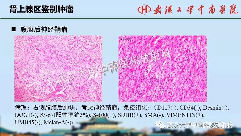 【PPT】肾上腺形态、功能及良恶性肿瘤CT影像诊断