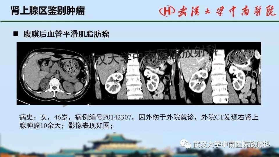 【PPT】肾上腺形态、功能及良恶性肿瘤CT影像诊断