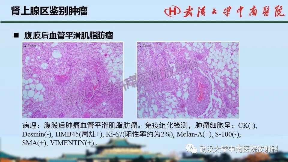 【PPT】肾上腺形态、功能及良恶性肿瘤CT影像诊断