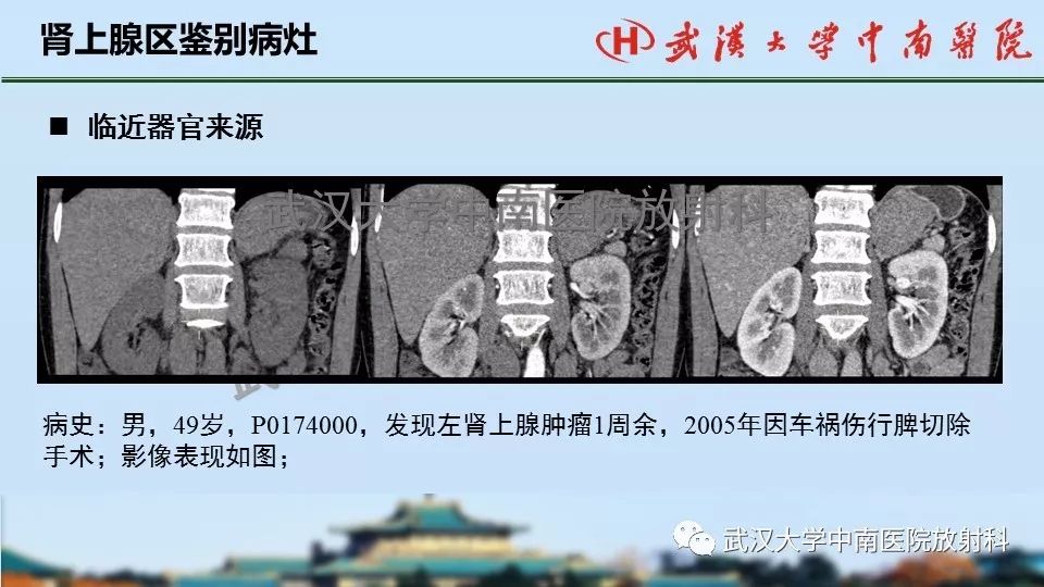 【PPT】肾上腺形态、功能及良恶性肿瘤CT影像诊断