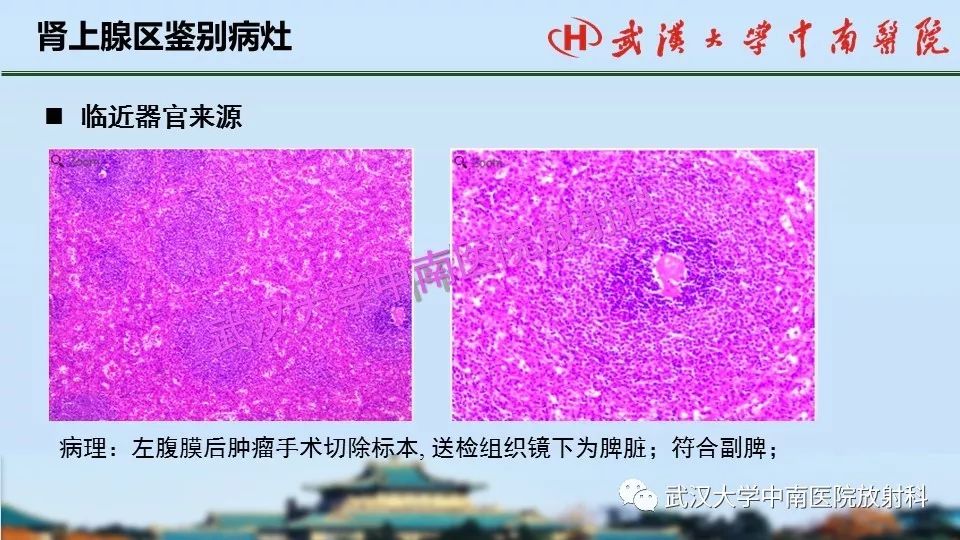 【PPT】肾上腺形态、功能及良恶性肿瘤CT影像诊断