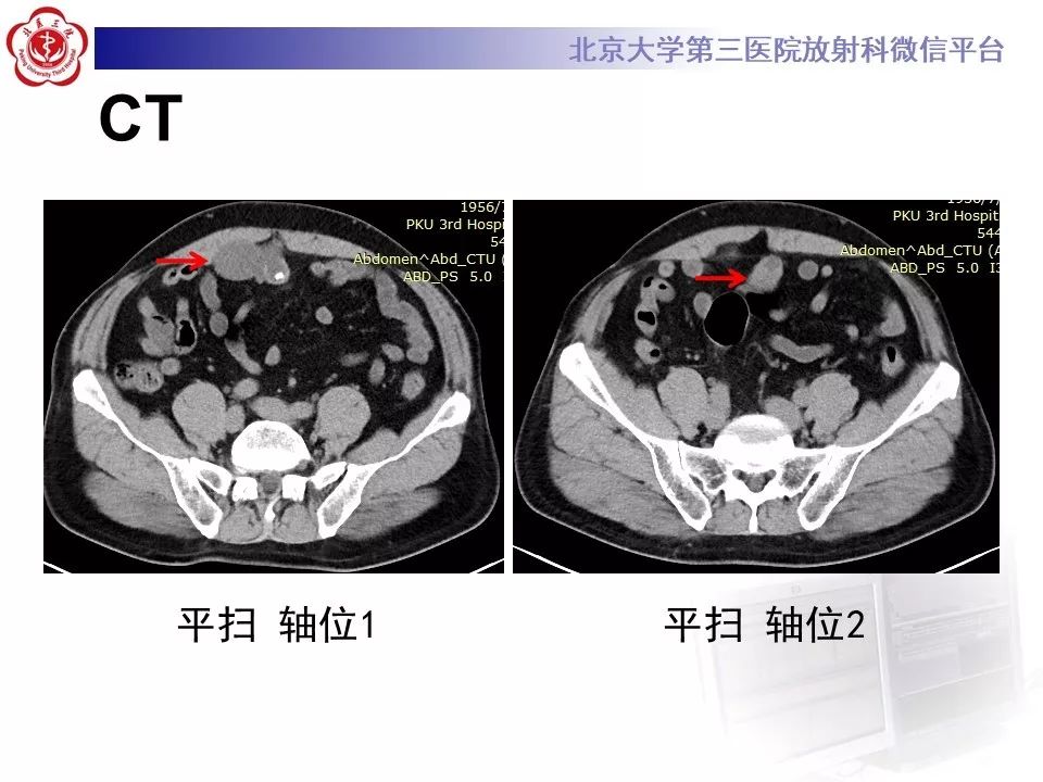 【病例】脐尿管癌1例CT影像