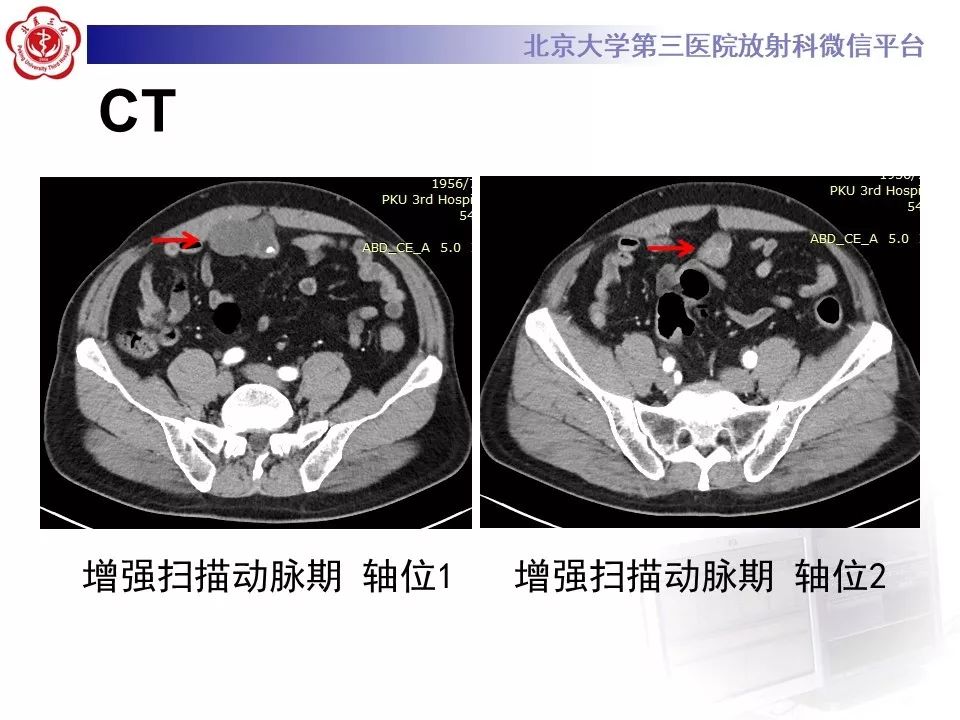 【病例】脐尿管癌1例CT影像