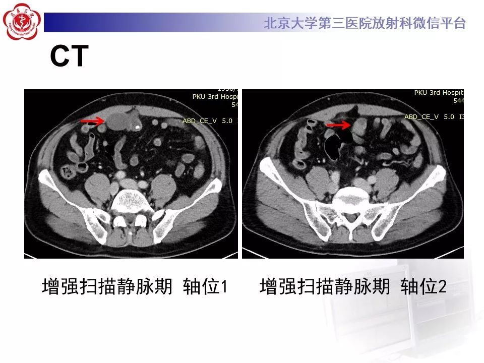 【病例】脐尿管癌1例CT影像