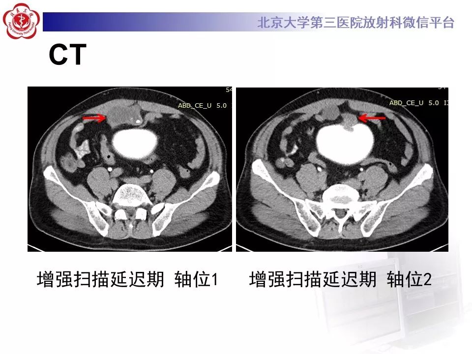 【病例】脐尿管癌1例CT影像