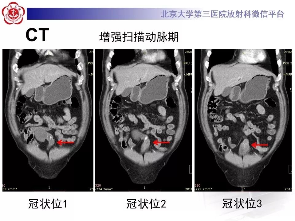 【病例】脐尿管癌1例CT影像