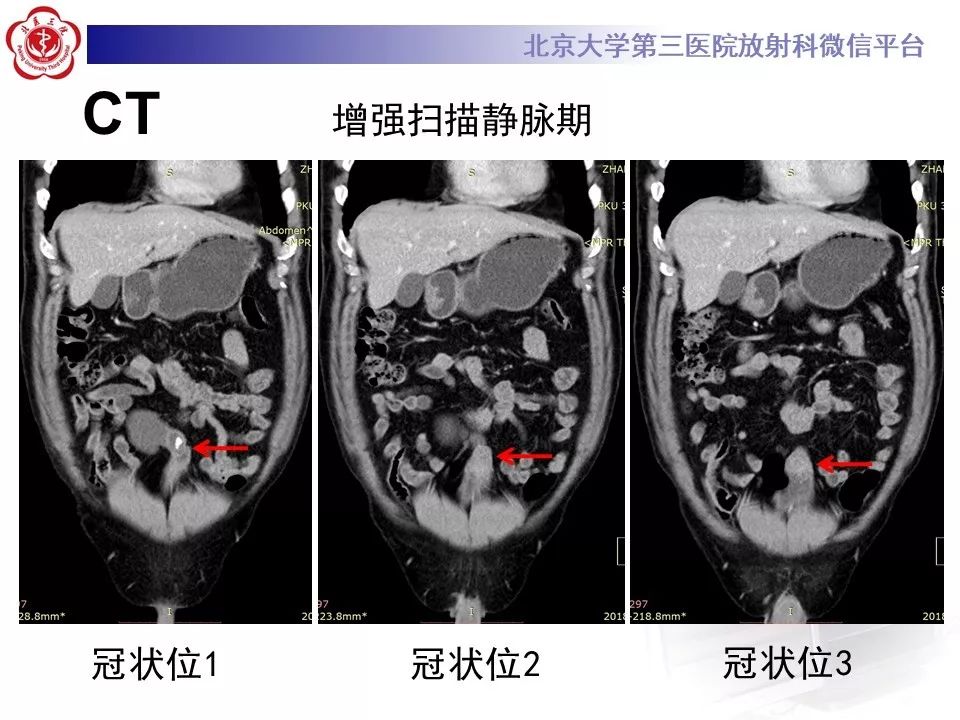 【病例】脐尿管癌1例CT影像