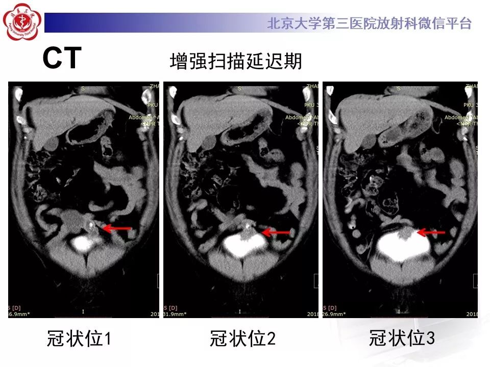 【病例】脐尿管癌1例CT影像