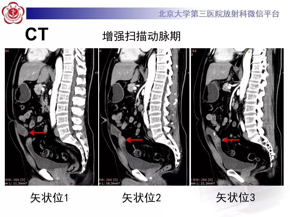 【病例】脐尿管癌1例CT影像