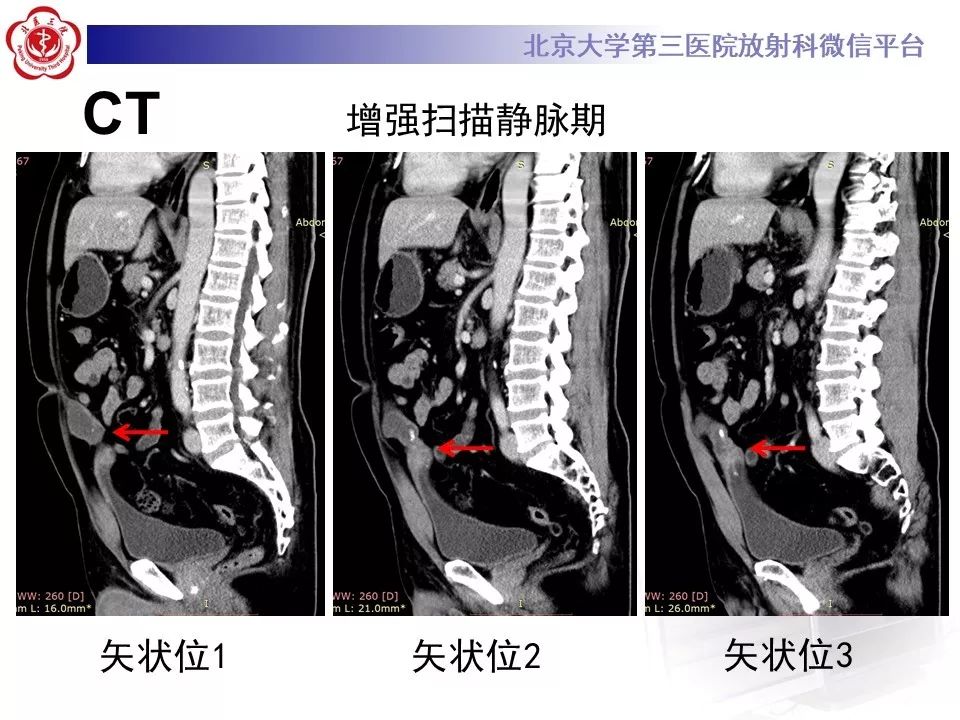【病例】脐尿管癌1例CT影像