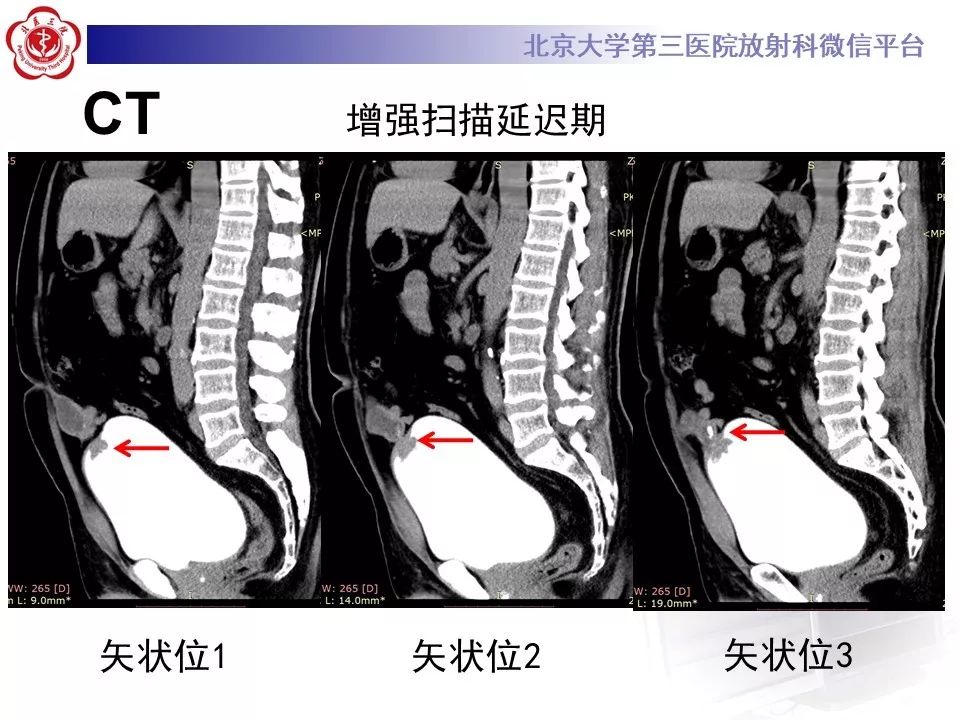 【病例】脐尿管癌1例CT影像