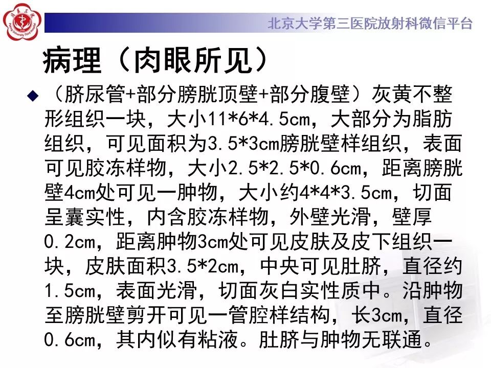 【病例】脐尿管癌1例CT影像