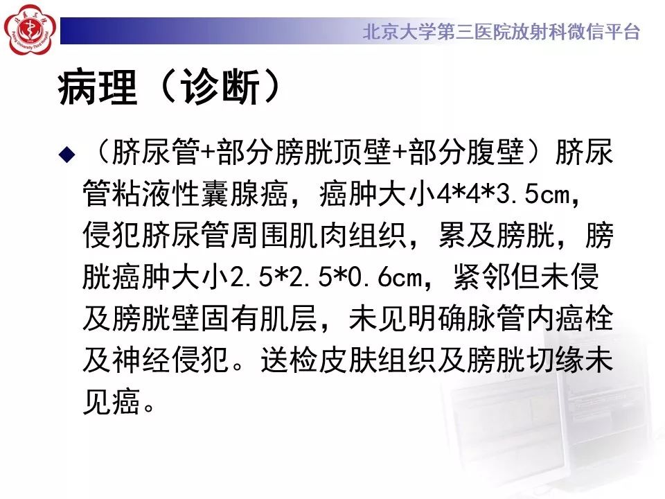 【病例】脐尿管癌1例CT影像