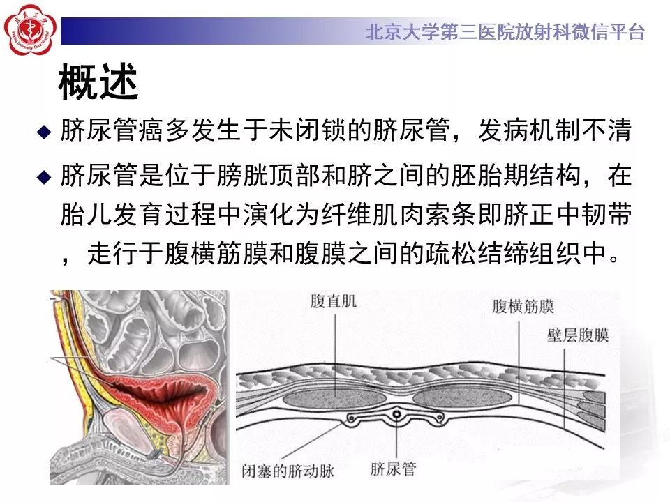 【病例】脐尿管癌1例CT影像