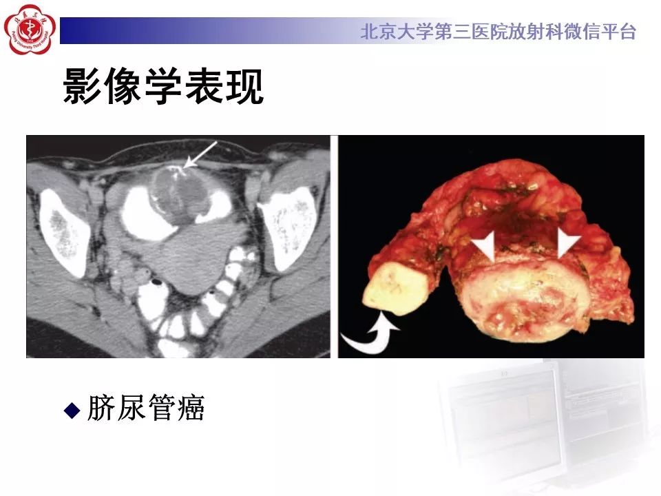 【病例】脐尿管癌1例CT影像