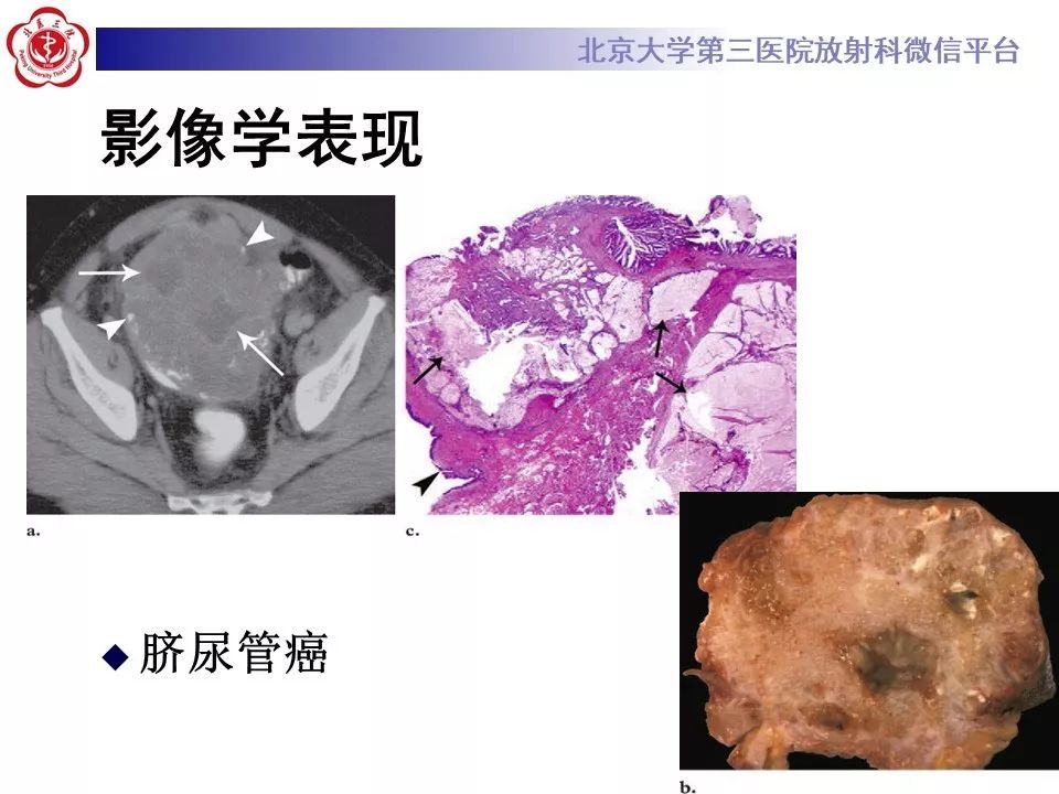 【病例】脐尿管癌1例CT影像