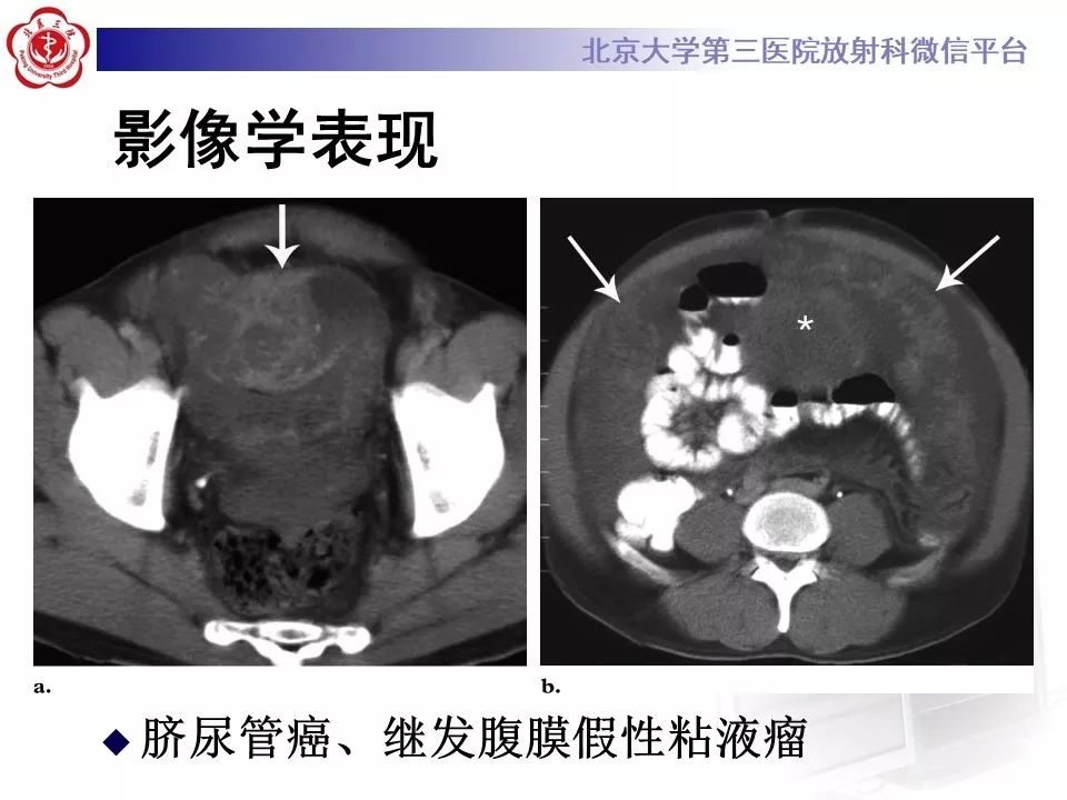 【病例】脐尿管癌1例CT影像