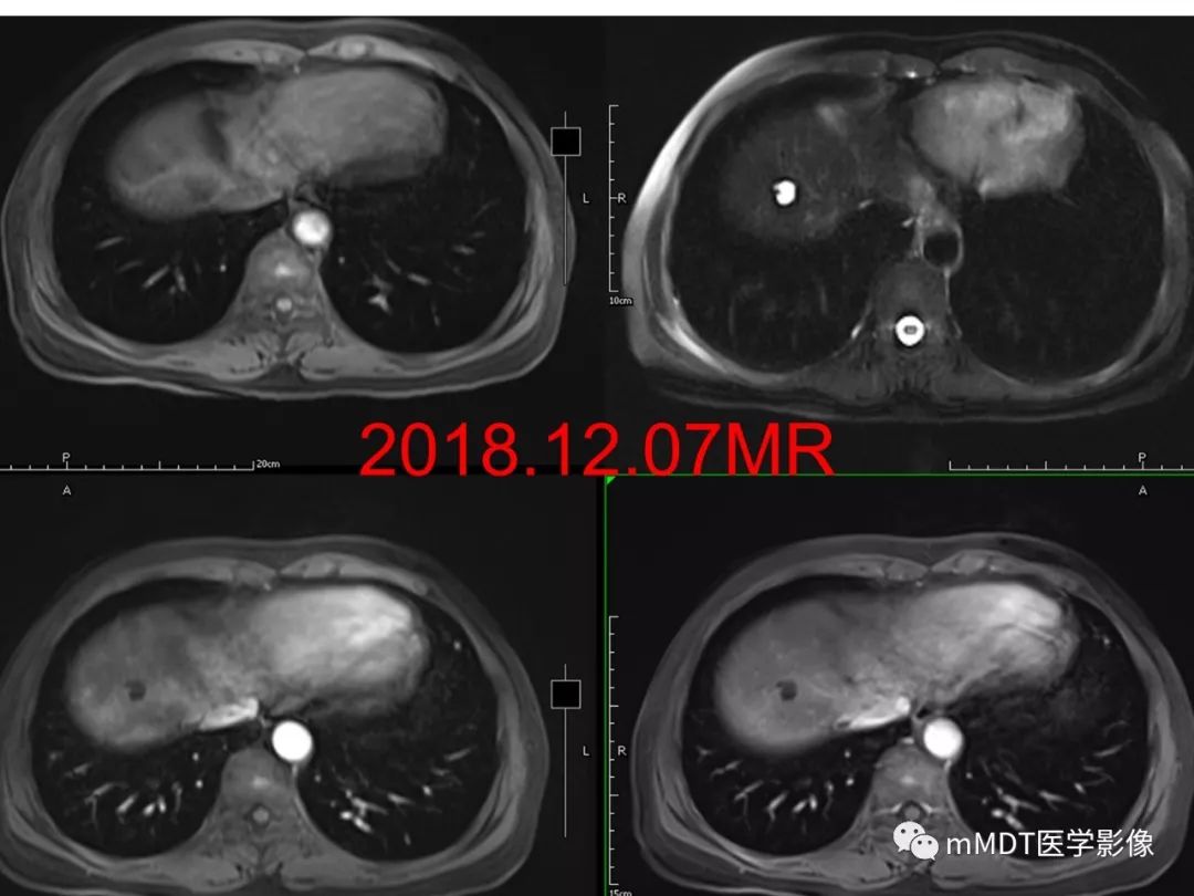 【病例】遗传性出血性毛细血管扩张症1例CT及MR影像