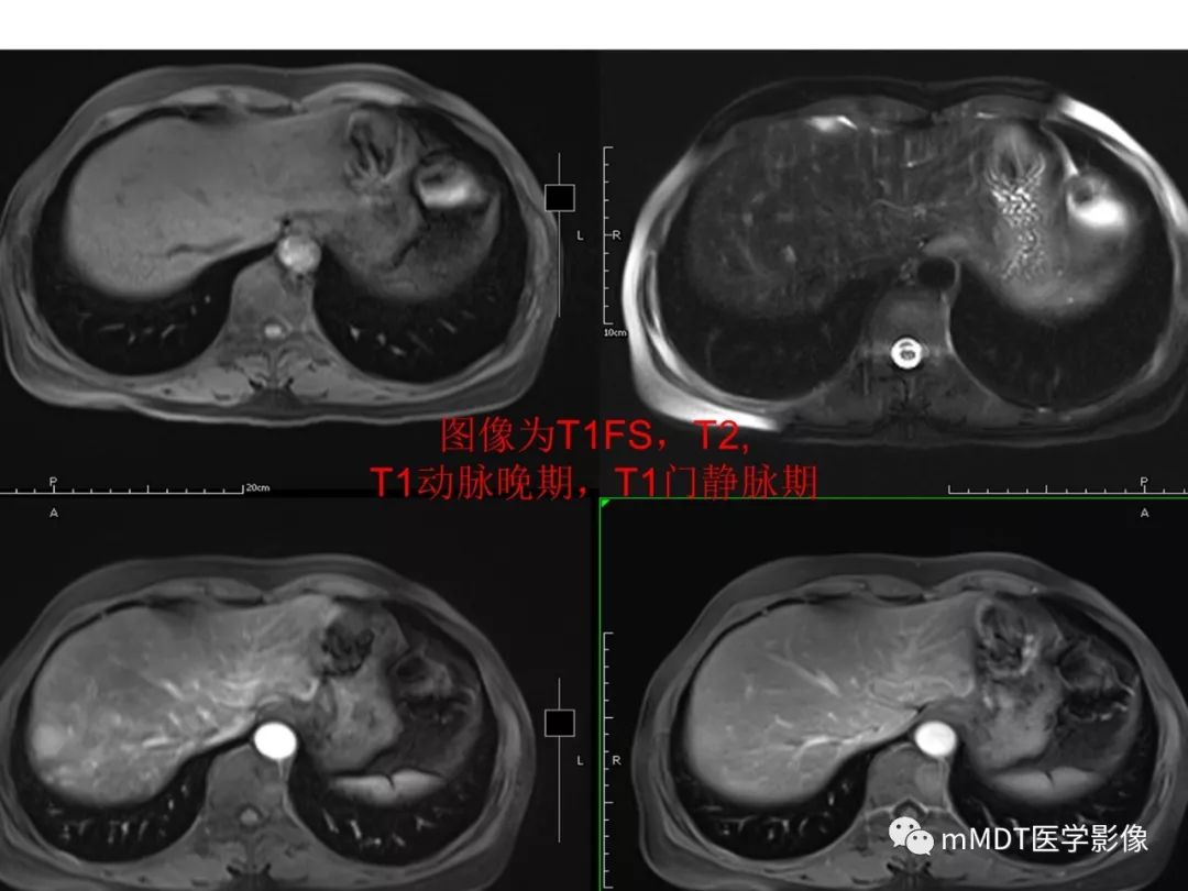 【病例】遗传性出血性毛细血管扩张症1例CT及MR影像