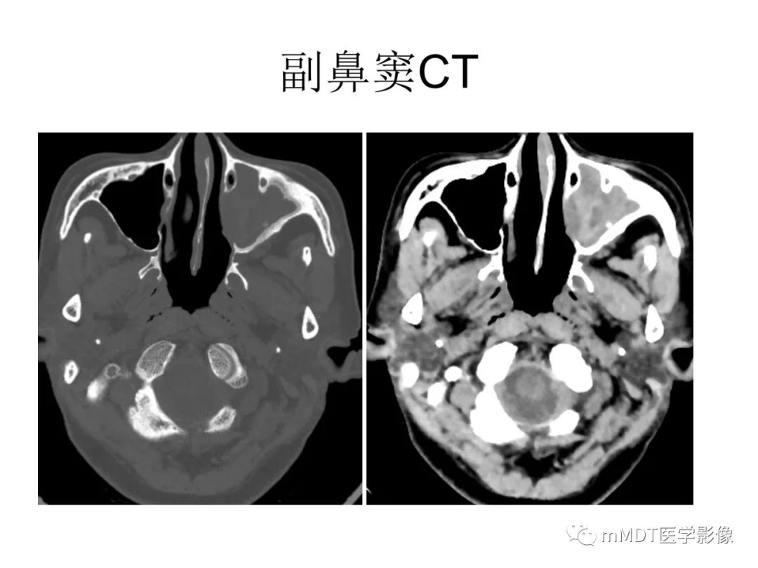 【病例】遗传性出血性毛细血管扩张症1例CT及MR影像