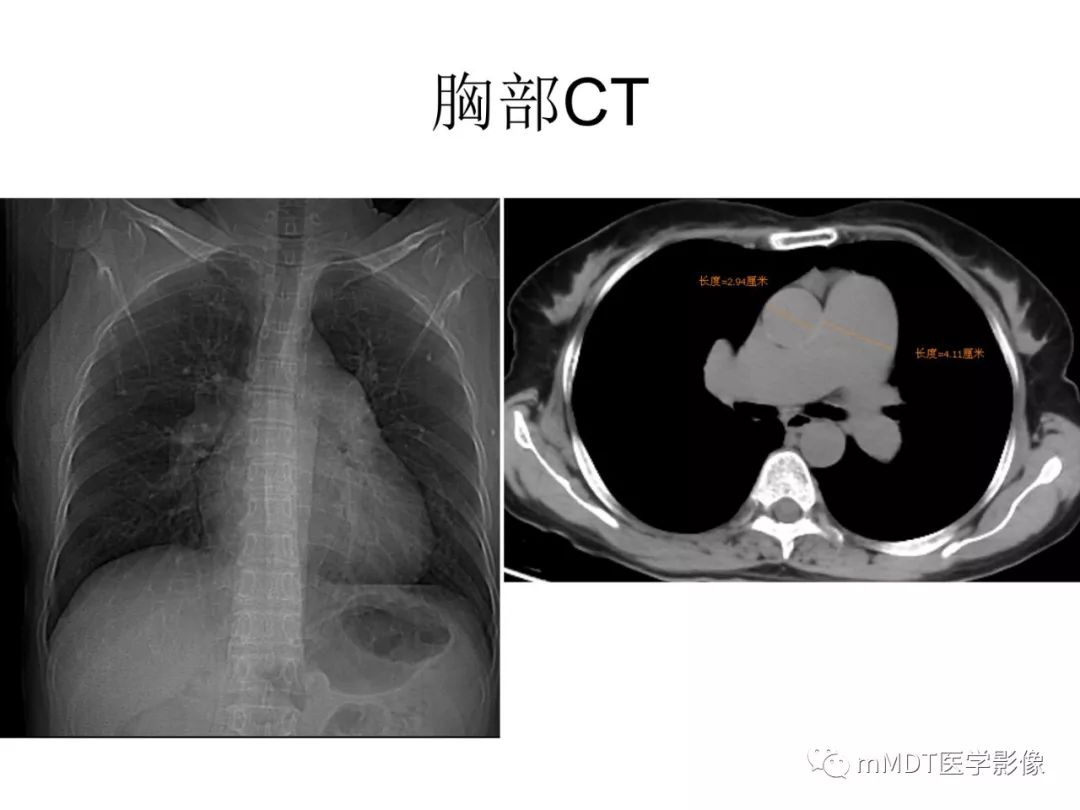 【病例】遗传性出血性毛细血管扩张症1例CT及MR影像