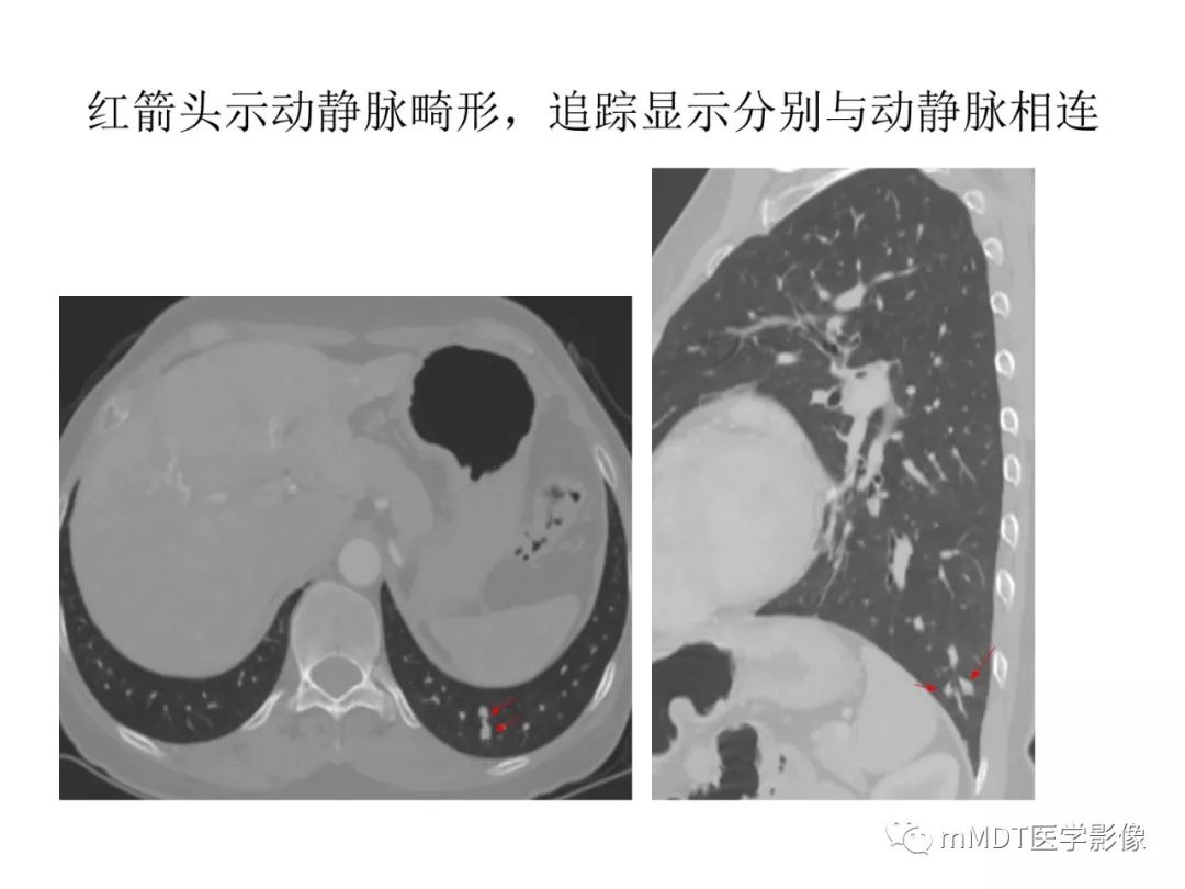 【病例】遗传性出血性毛细血管扩张症1例CT及MR影像