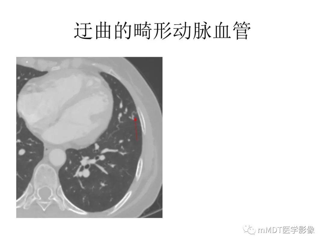 【病例】遗传性出血性毛细血管扩张症1例CT及MR影像