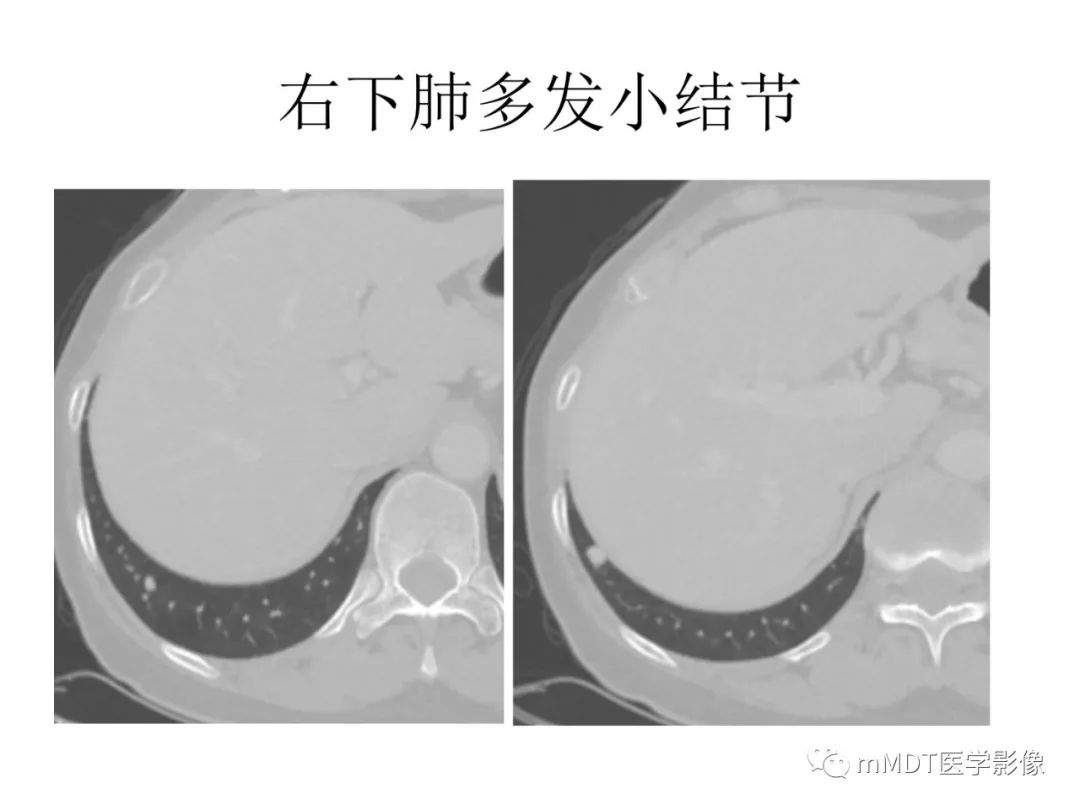 【病例】遗传性出血性毛细血管扩张症1例CT及MR影像