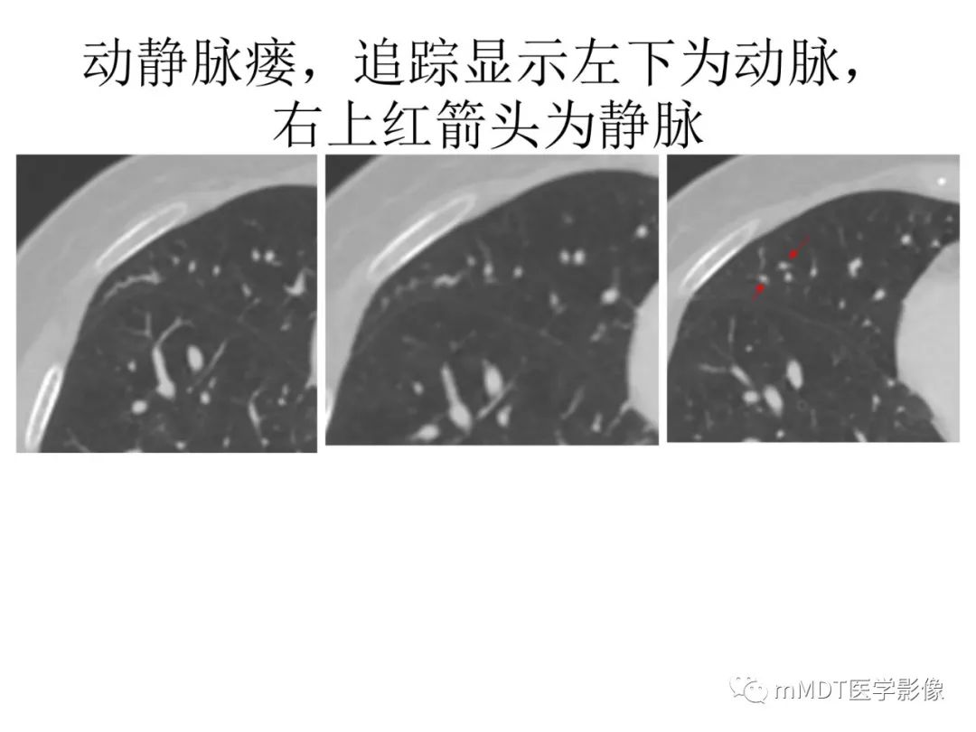 【病例】遗传性出血性毛细血管扩张症1例CT及MR影像