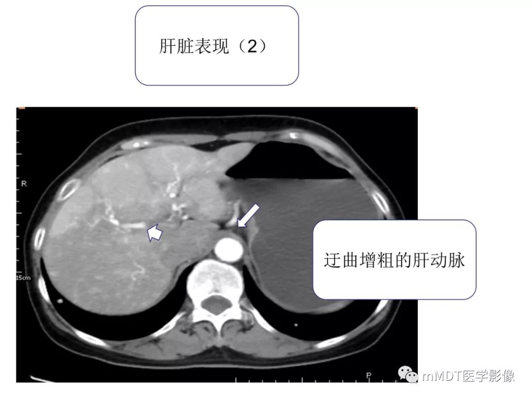 【病例】遗传性出血性毛细血管扩张症1例CT及MR影像