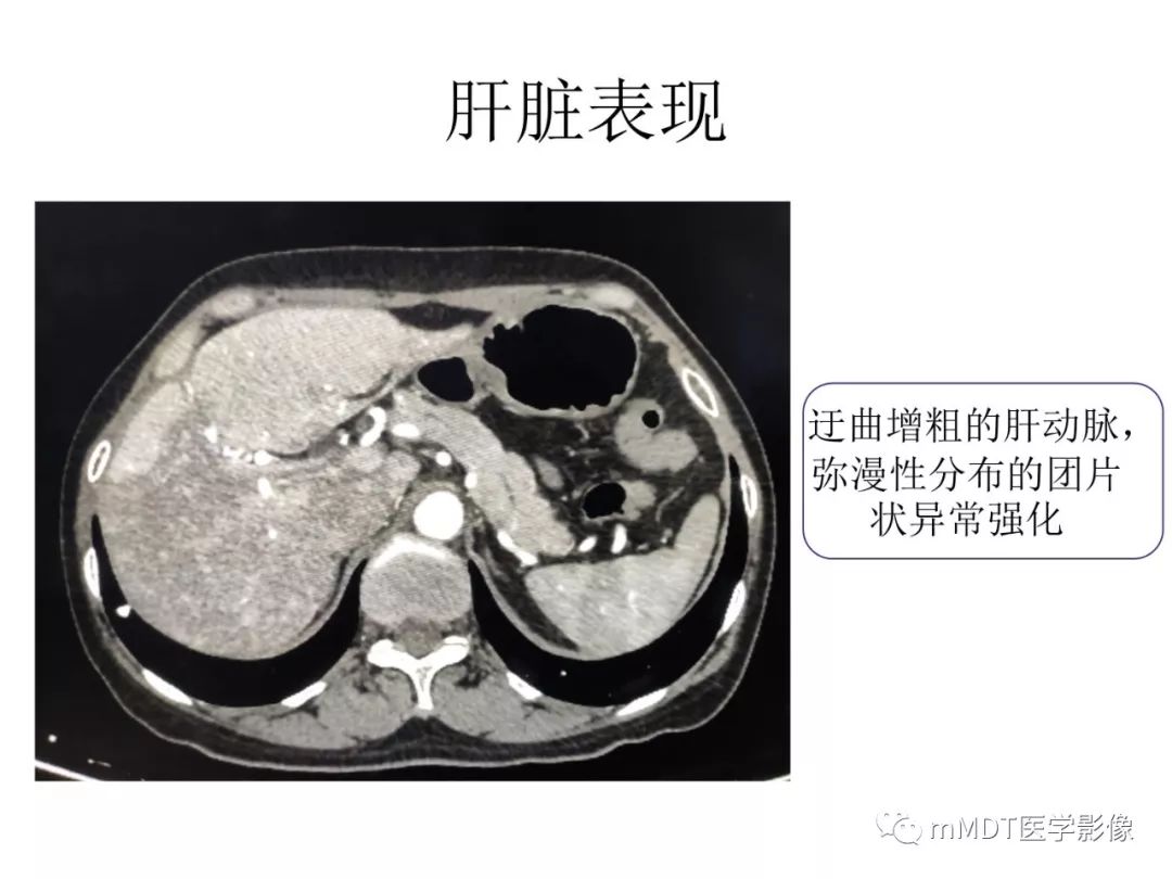【病例】遗传性出血性毛细血管扩张症1例CT及MR影像