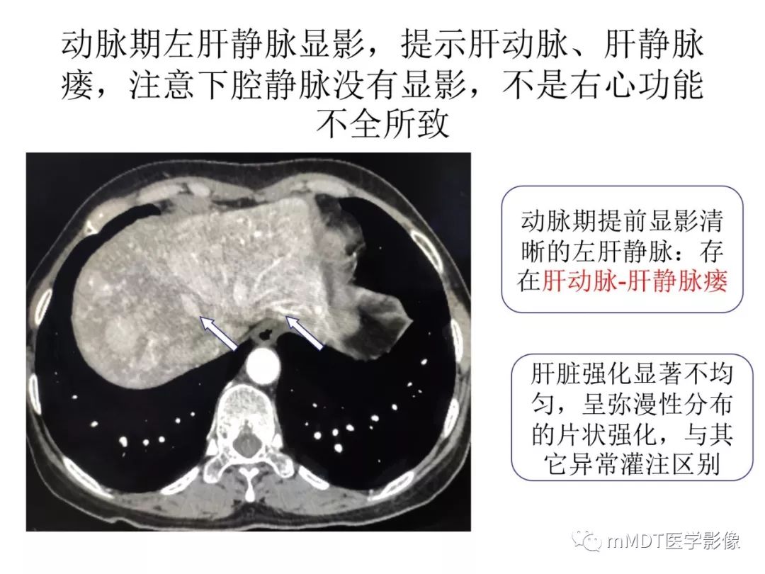 【病例】遗传性出血性毛细血管扩张症1例CT及MR影像