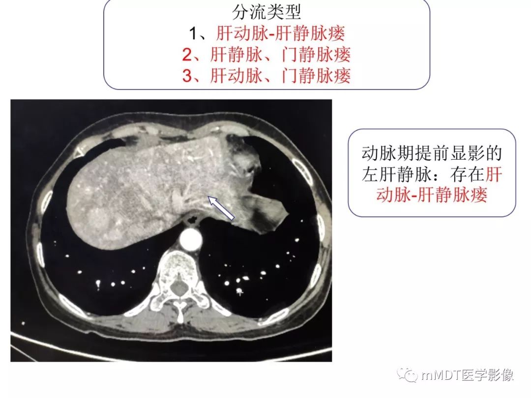 【病例】遗传性出血性毛细血管扩张症1例CT及MR影像