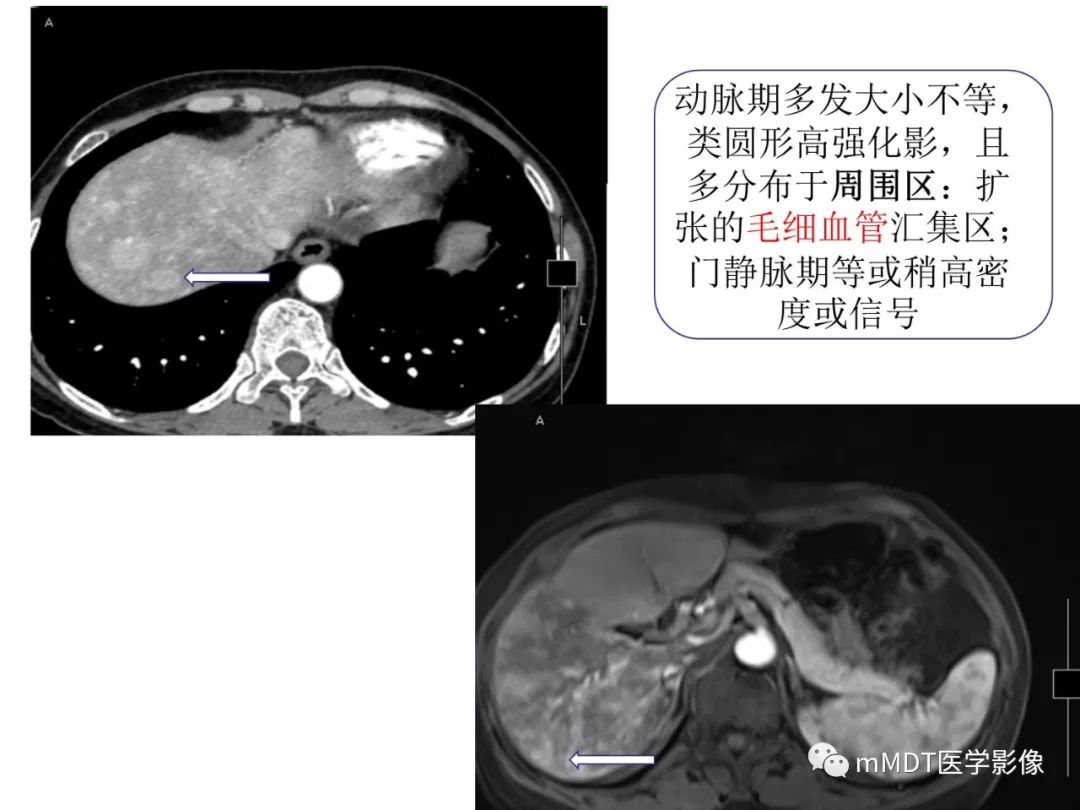【病例】遗传性出血性毛细血管扩张症1例CT及MR影像