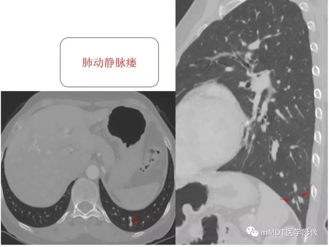 【病例】遗传性出血性毛细血管扩张症1例CT及MR影像