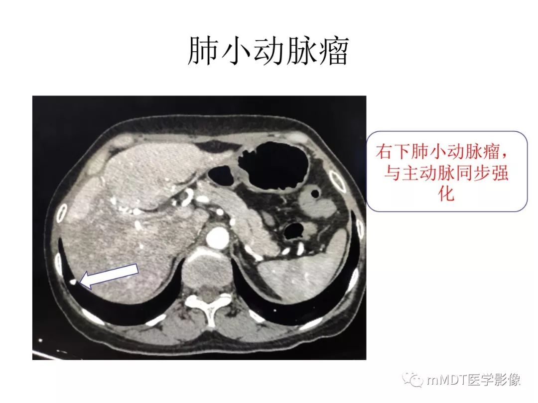 【病例】遗传性出血性毛细血管扩张症1例CT及MR影像