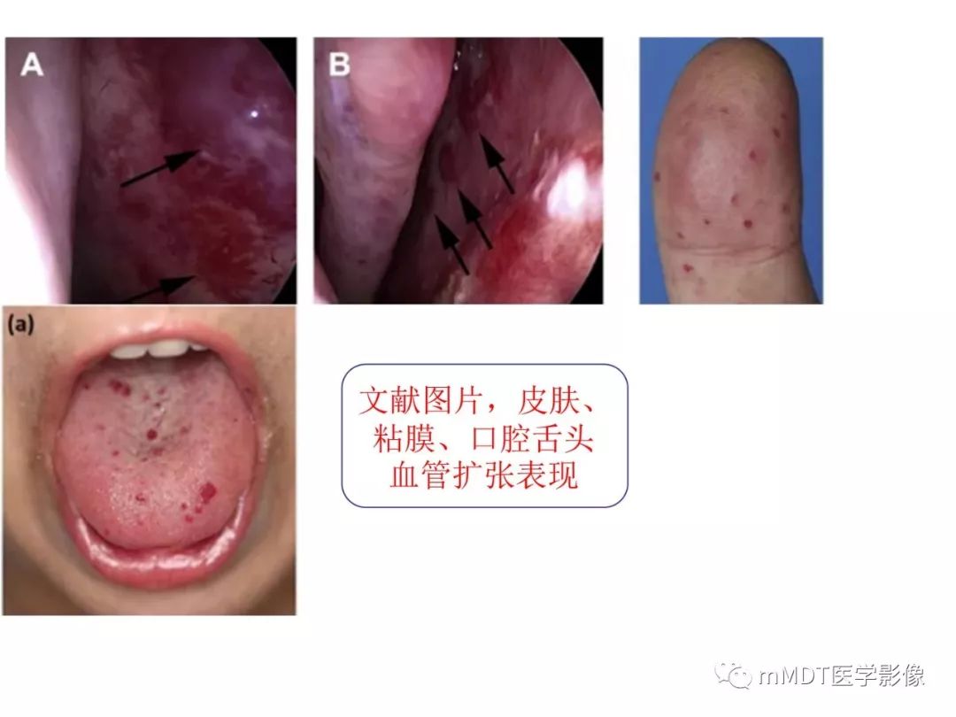 【病例】遗传性出血性毛细血管扩张症1例CT及MR影像