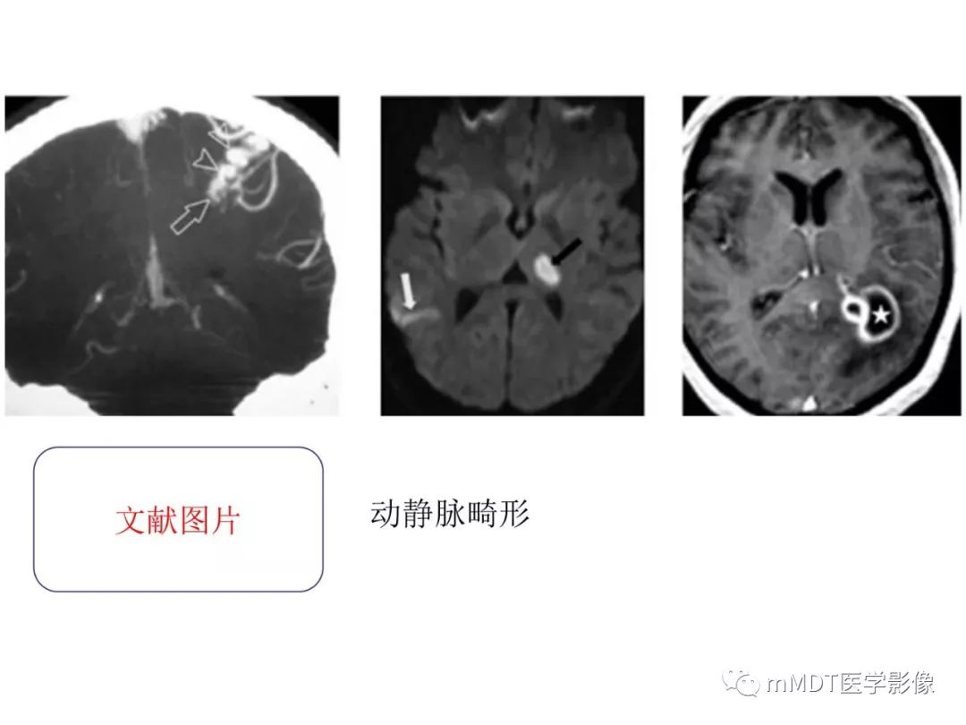【病例】遗传性出血性毛细血管扩张症1例CT及MR影像