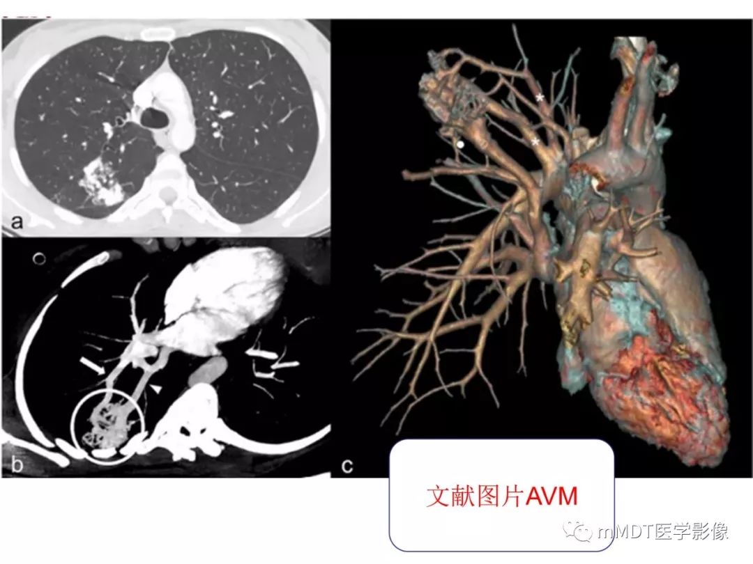 【病例】遗传性出血性毛细血管扩张症1例CT及MR影像