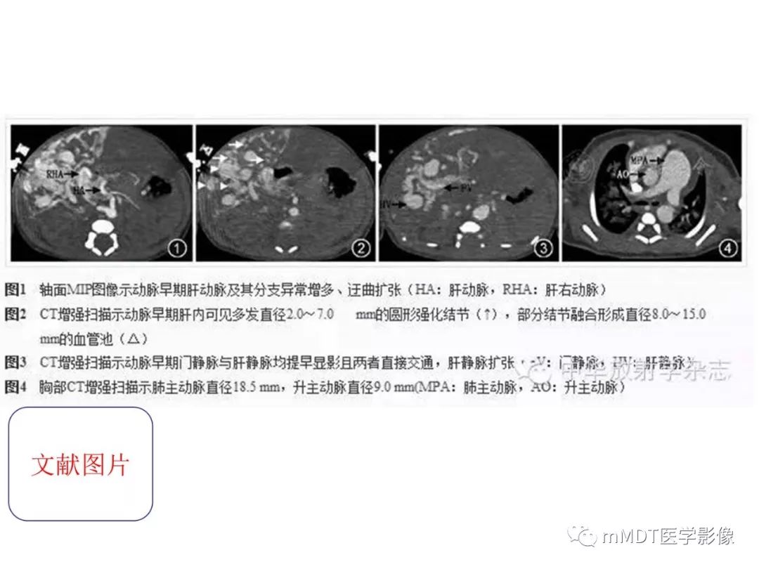 【病例】遗传性出血性毛细血管扩张症1例CT及MR影像