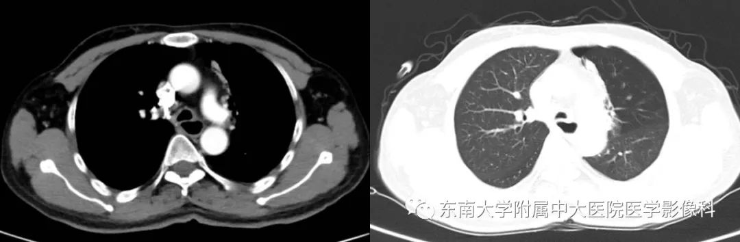 【病例】复发性多软骨炎1例CT影像