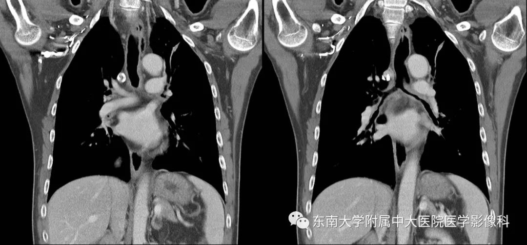 【病例】复发性多软骨炎1例CT影像