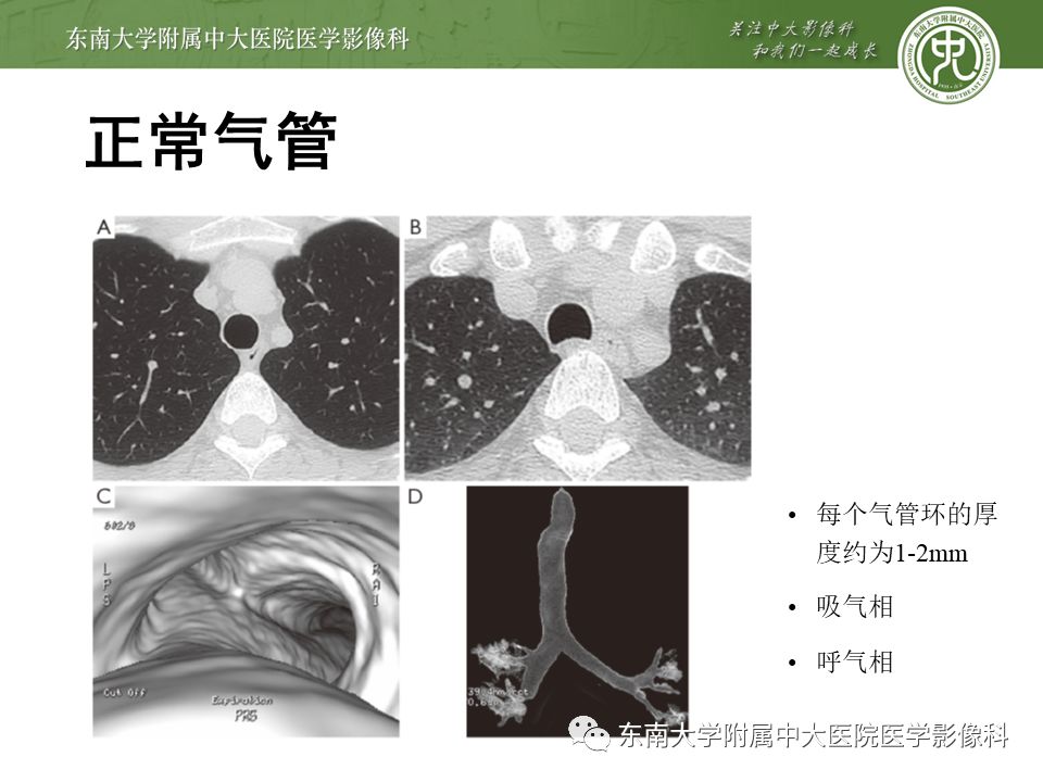 【病例】复发性多软骨炎1例CT影像