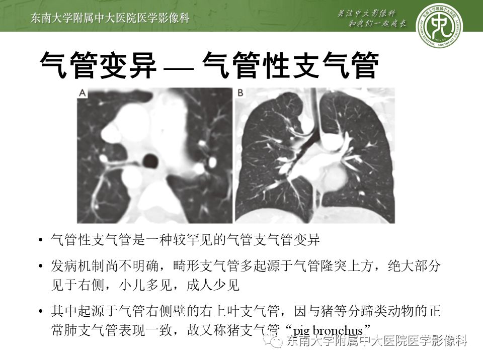 【病例】复发性多软骨炎1例CT影像