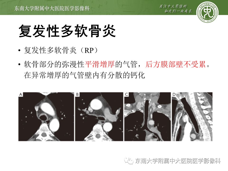 【病例】复发性多软骨炎1例CT影像