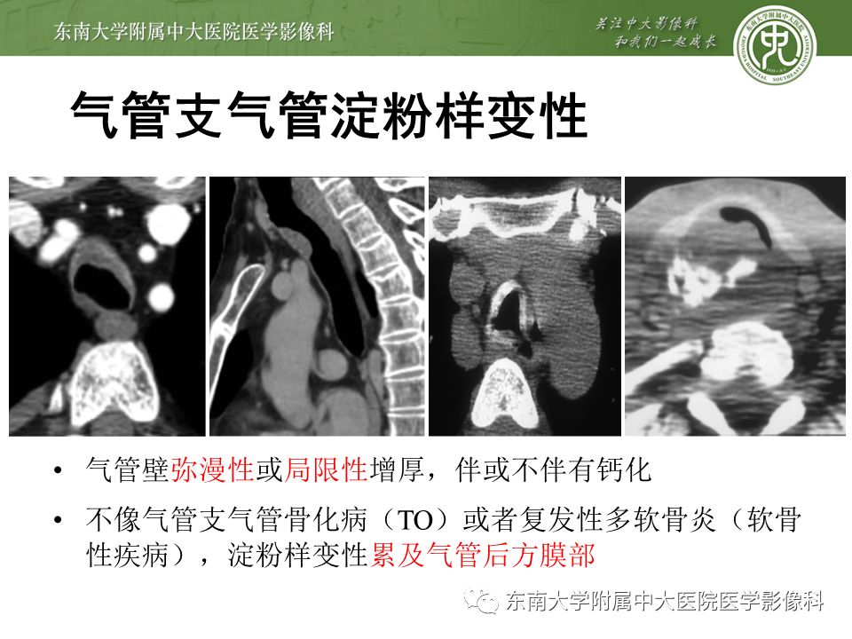 【病例】复发性多软骨炎1例CT影像