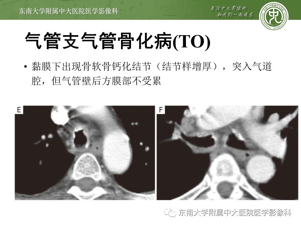 【病例】复发性多软骨炎1例CT影像