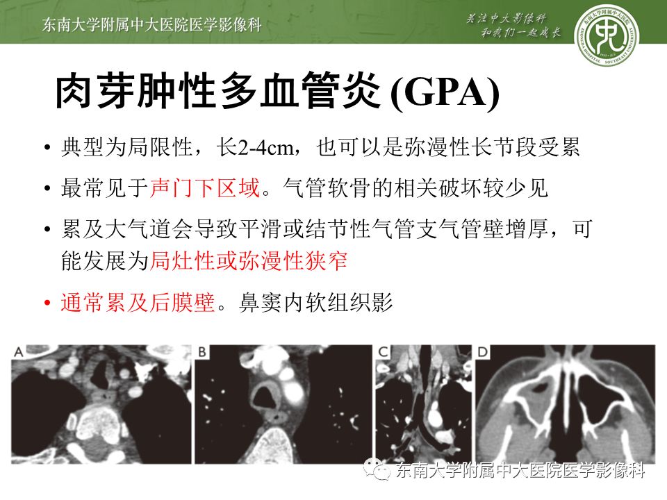 【病例】复发性多软骨炎1例CT影像