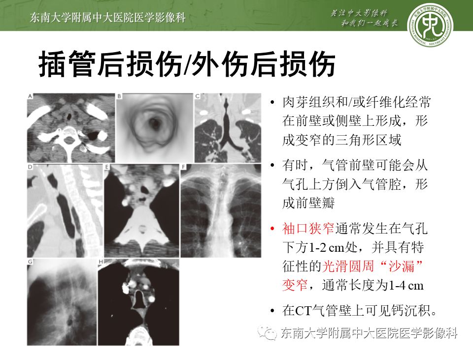 【病例】复发性多软骨炎1例CT影像